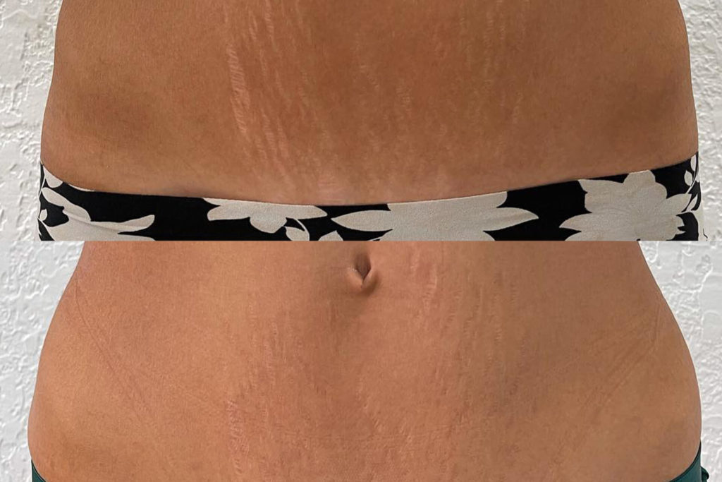 stretchmarks_camouflage_Treatment